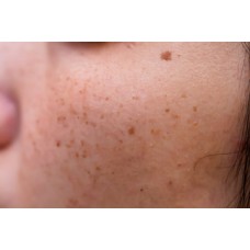 Skin Lightening & Dark Spot Facial