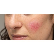 Rosacea Sensitive Skin Facial